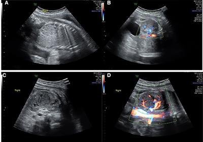 Prenatal diagnosis and postnatal management of congenital mesoblastic nephroma: A case report and literature review